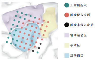运动区胶质瘤皮层脑电活动特征