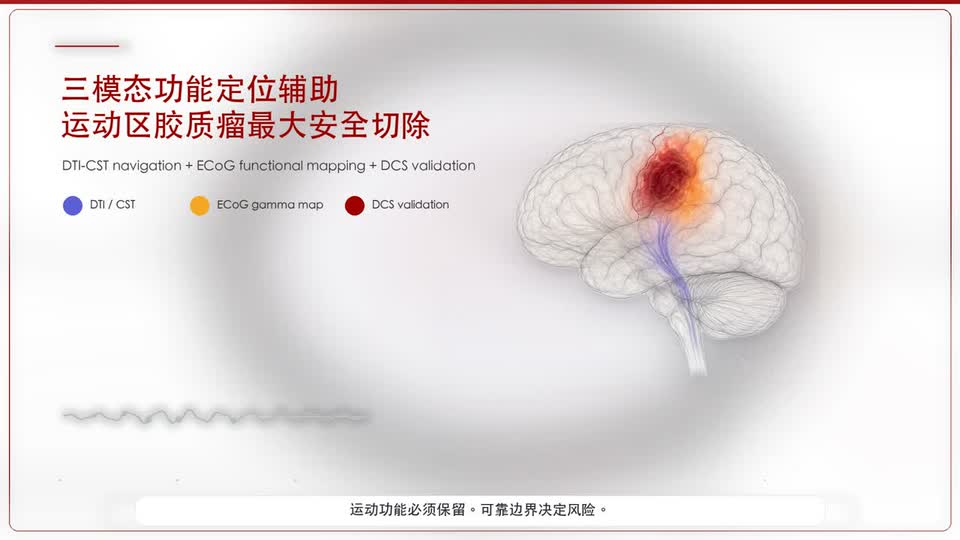每日经济新闻报道华西侵入式脑机接口切除脑胶质瘤取得突破